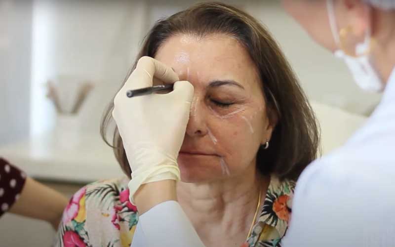 Rejuvenescimento com harmonização facial sem exageros
