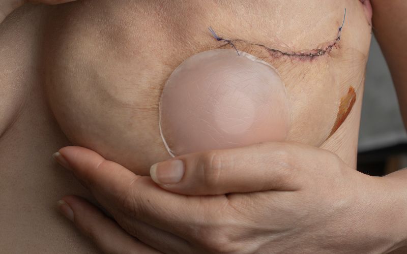 Tatuagem de Mama: reconstruir a aréola com pigmento resolve a perda causada pelo câncer.